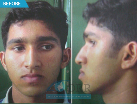 Orthognathic Surgery in Chennai